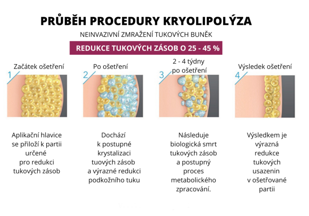Kryolipolýza Kryolipolýza