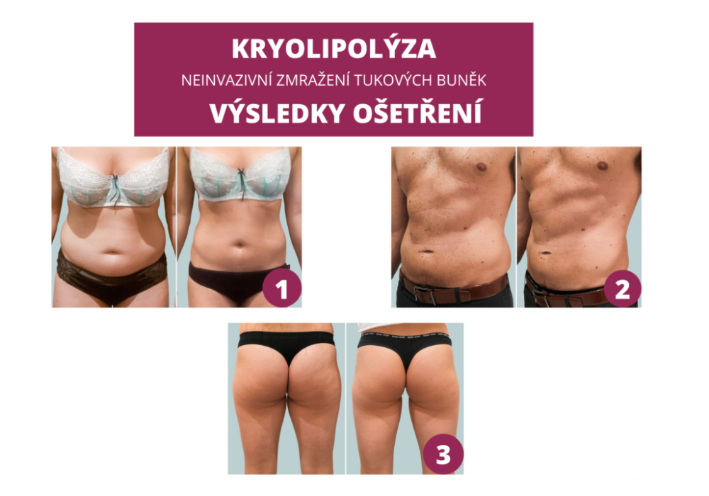 Kryolipolýza Kryolipolýza